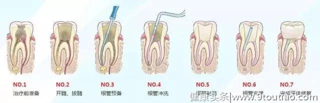 雅悦齿科：为什么根管治疗费用那么贵？那可全是牙医的技术啊！