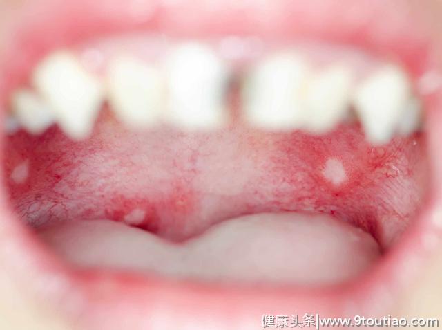口腔癌不可忽视！口腔有这两个症状，或是癌变到来的“信号”