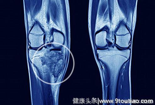 骨癌是怎么回事，哪些因素会增加骨癌？