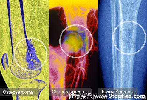 骨癌是怎么回事，哪些因素会增加骨癌？