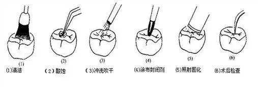 90% 儿童蛀牙可预防？儿科医生强烈推荐这 4 种办法