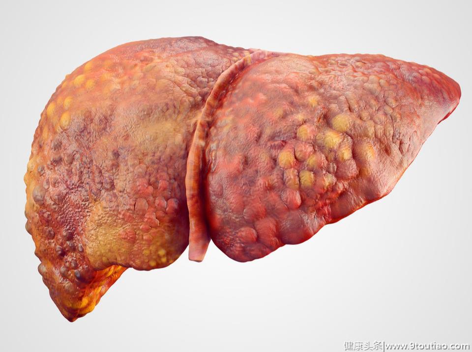 野蛮生长的肝硬化，比肝癌还可怕，引起肝硬化的十大病因早知可防