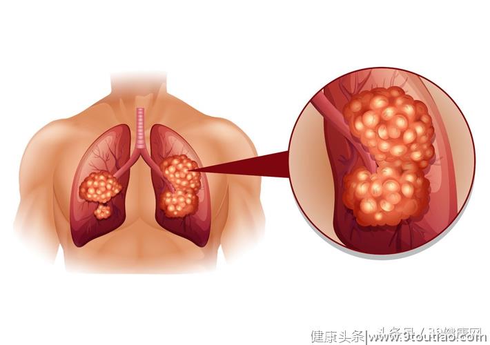 出现这种肺炎小心是肺癌，医生教你3步进行鉴别！